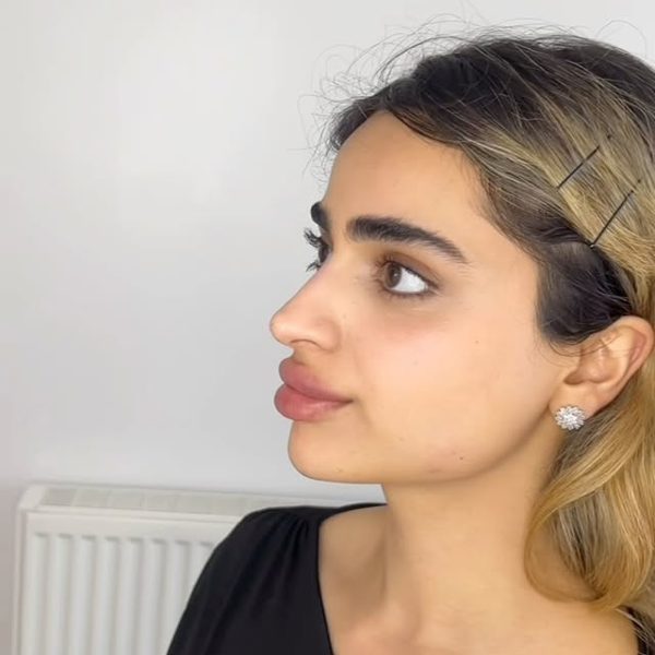 Nose and lip balancing result